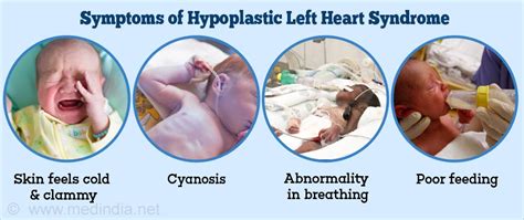 hypoplastic left heart syndrome symptoms